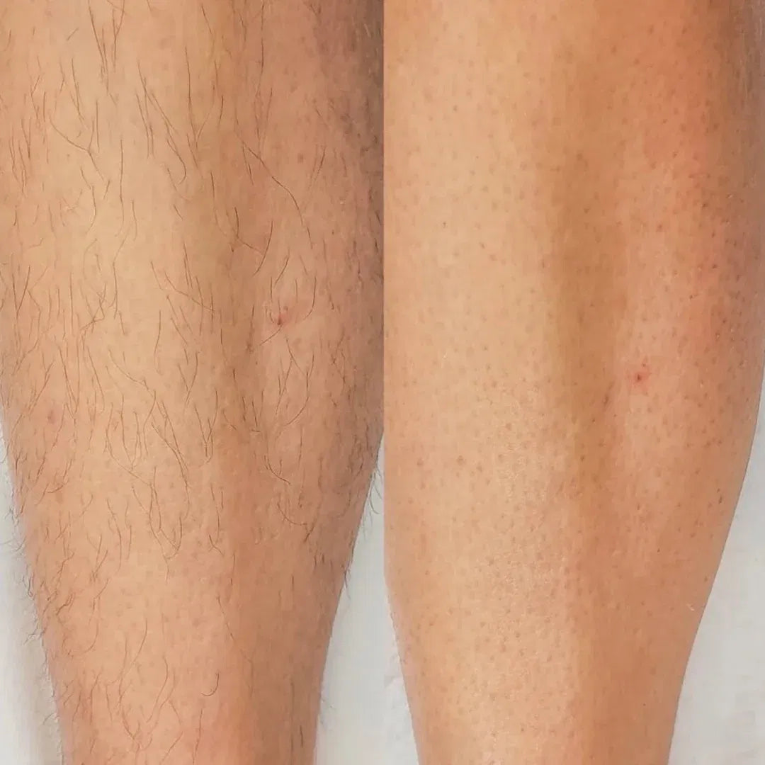 No more razor burns
